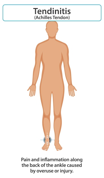 Achilles Tendonitis Illustration And Symptoms 410856527
